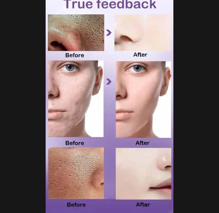 Uptown LA Blemish Removal Face Serum | Acne & Dark Spot Treatment